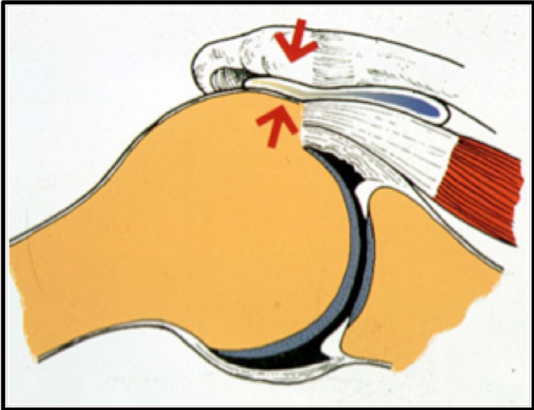 Tendinopathie dégénérative Centre Epaule Main de Besançon chirurgie orthopédique et
