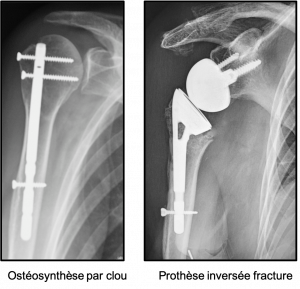 fracture ttt