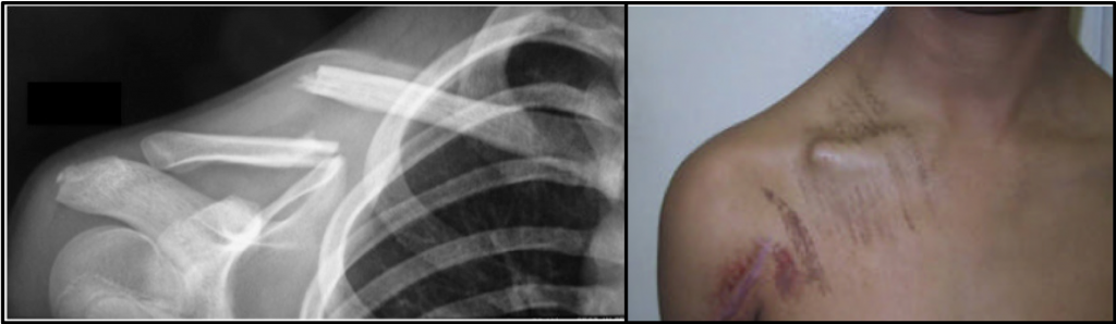 fracture clav