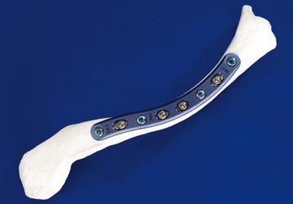 plaque clav os sec