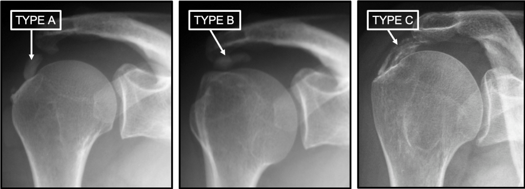 Tendinopathie calcifiante - Centre Epaule Main de Besançon ...